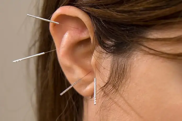 Иглоукалывание для похудения: можно ли снизить вес?