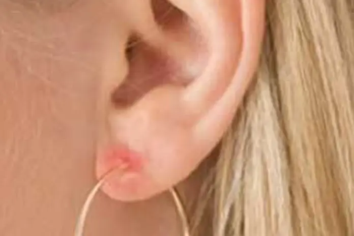 Аллергия на бижутерию: когда украшения перестают радовать