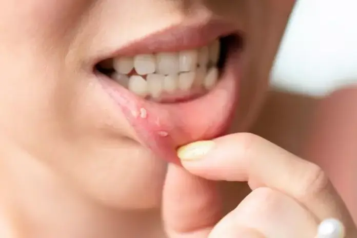Язвочки во рту: причины и лечение стоматита