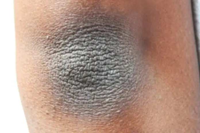 Грязные локти: причины, лечение и путь к ухоженной коже