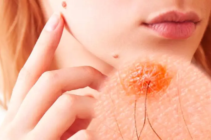 Волос из родинки: безопасно ли выдергивать